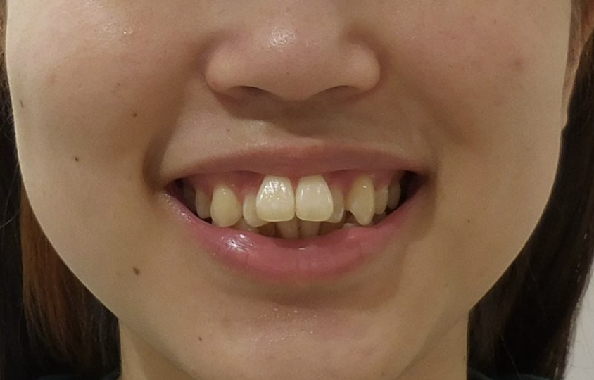 治療前（写真4）