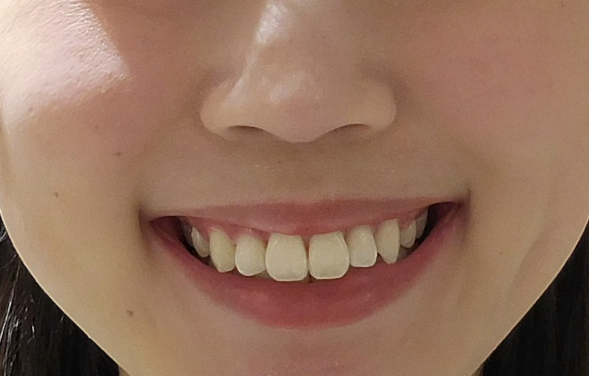 治療後（写真4）