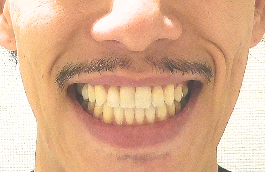 治療後（写真4）