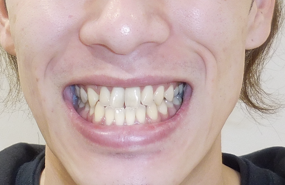 治療前（写真4）