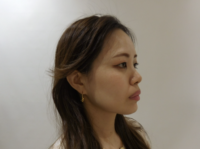 治療前（写真2）