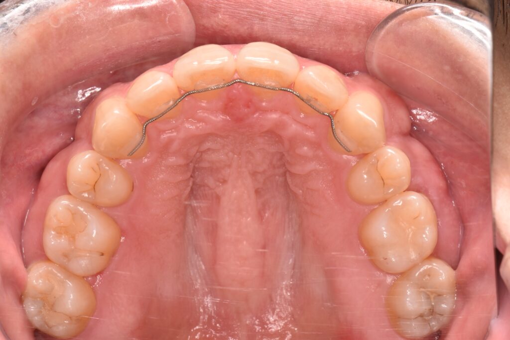 ワイヤーリテーナー