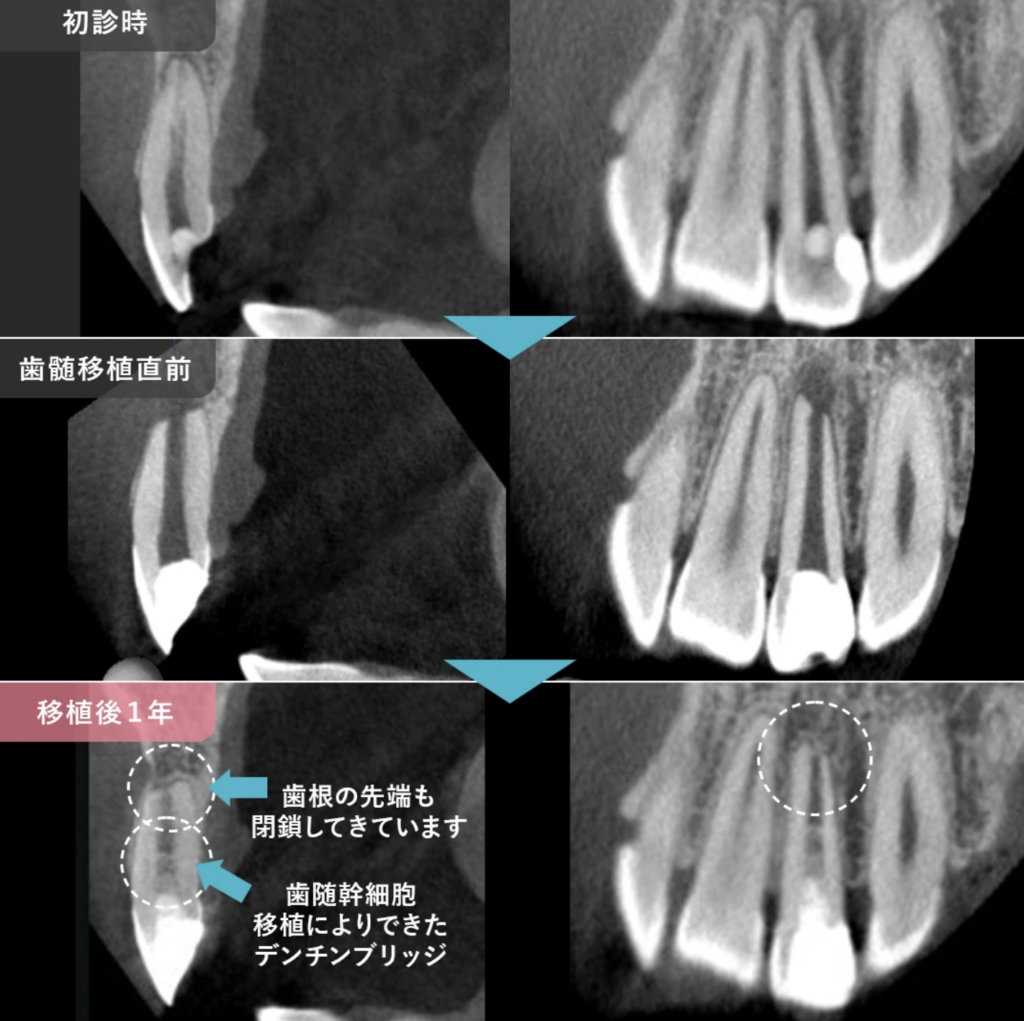歯髄再生治療画像