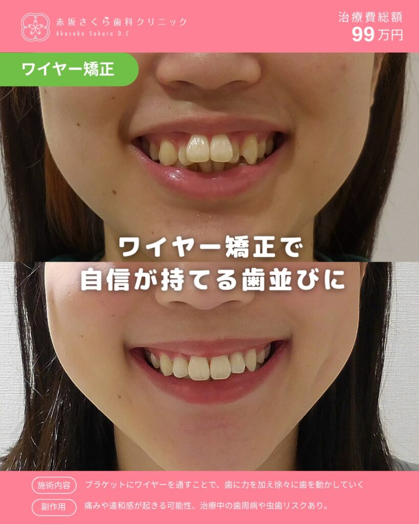 治療：ワイヤー矯正