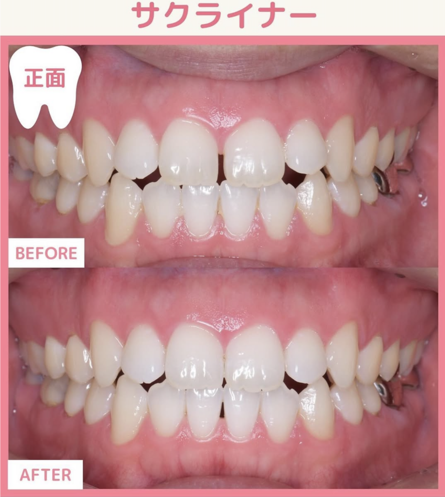 マウスピース矯正 