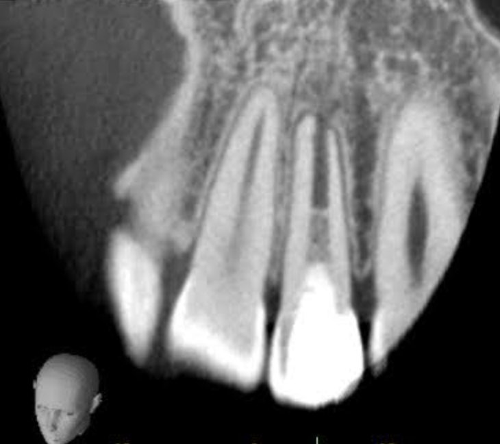 根尖切除術後３ヶ月後