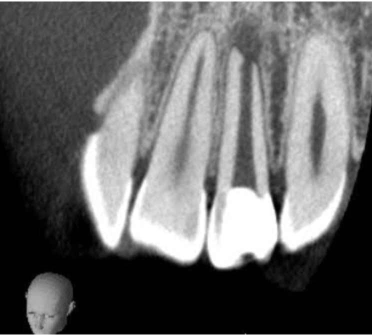 根尖切除術を行なった左上２番（治療前）