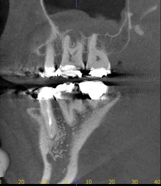 根尖病変が上顎洞まで波及し、レントゲン上に上顎洞が白い影ができて歯性上顎洞炎になっている