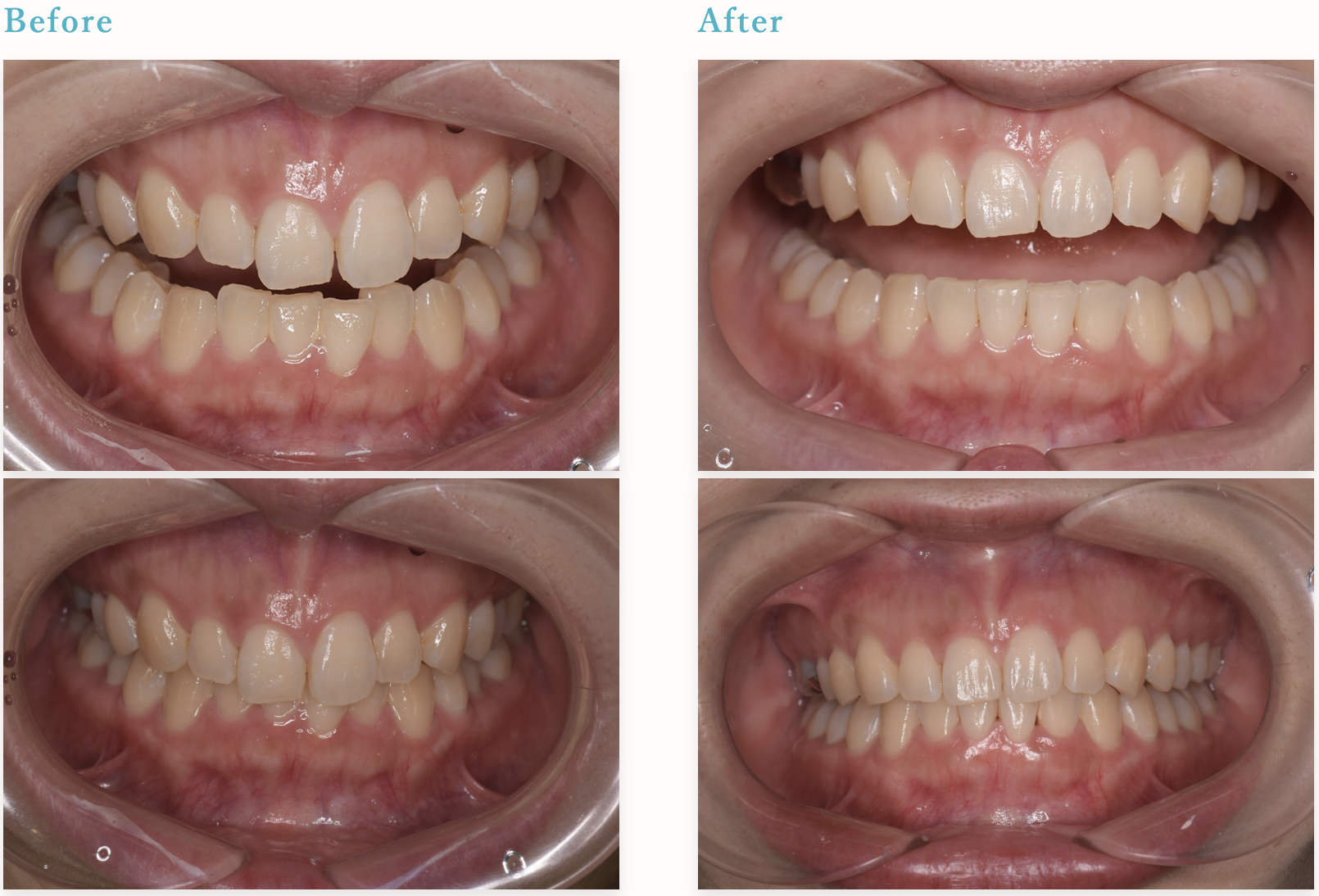 赤坂さくら歯科クリニックのインビザラインの症例写真