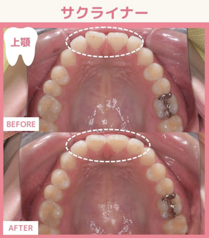 マウスピース（サクライナー）