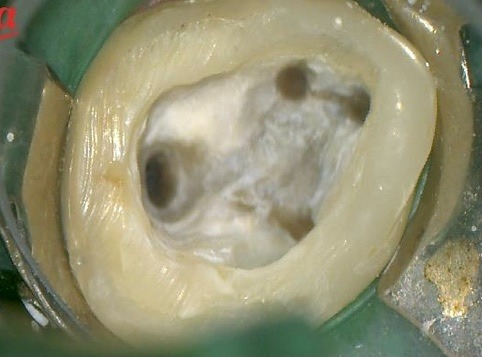 根管治療で洗浄された歯牙