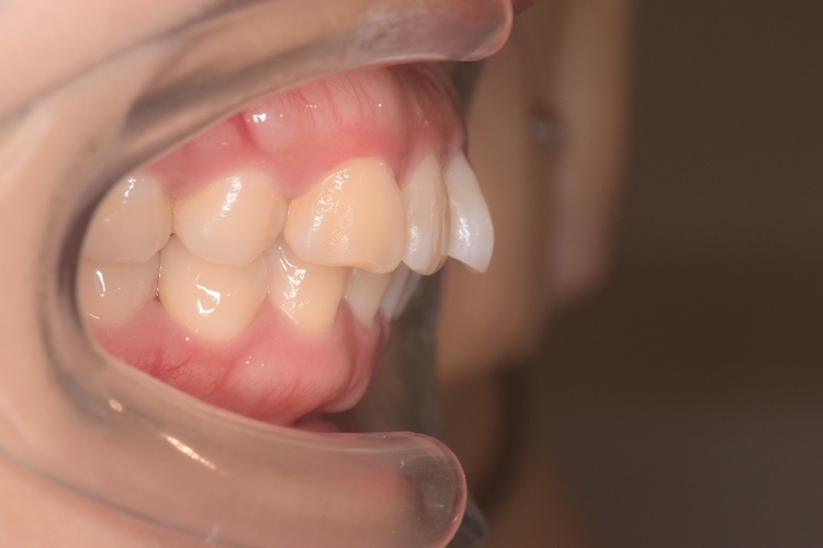 治療前（写真1）