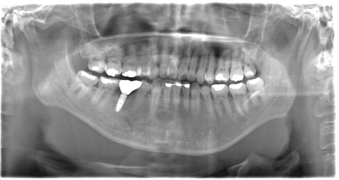 治療後（写真2）