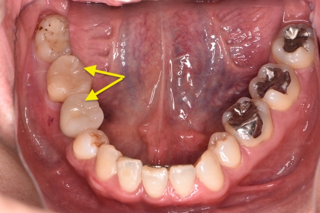 治療後（写真1）