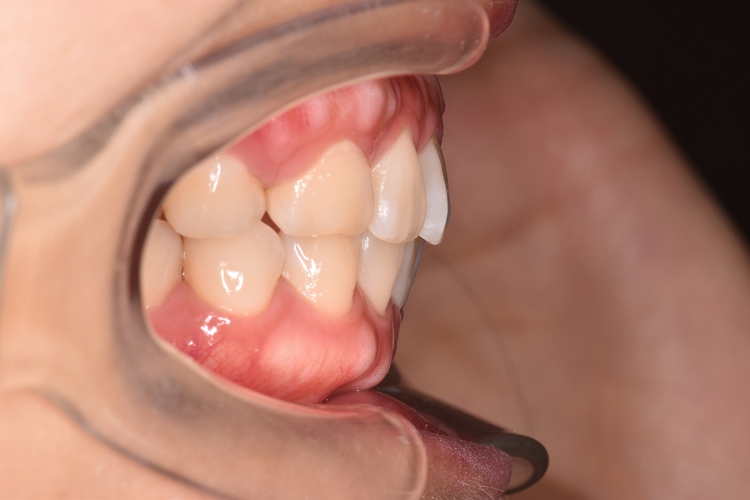 治療後（写真1）