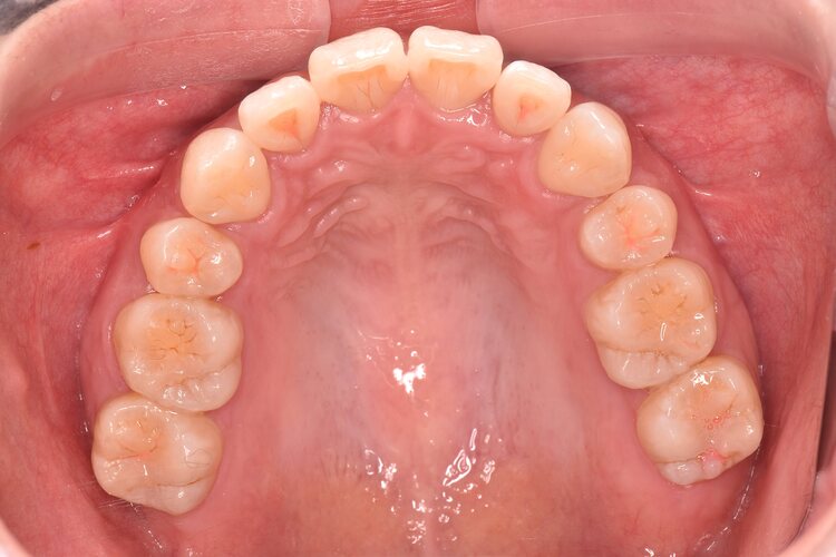 治療後（写真3）