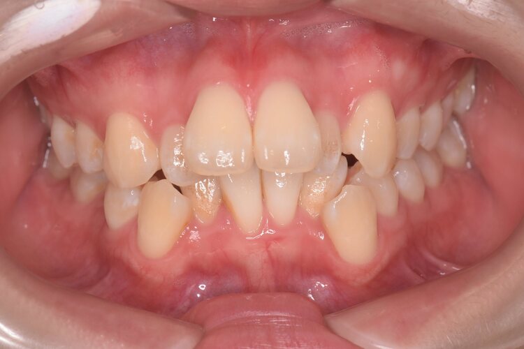 治療前（写真1）