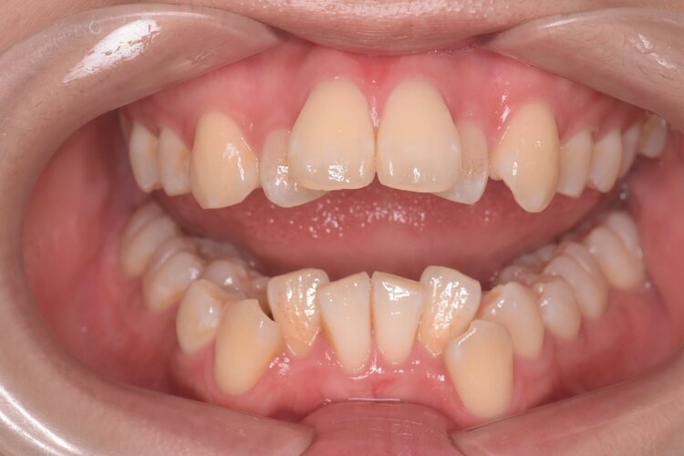 治療前（写真2）