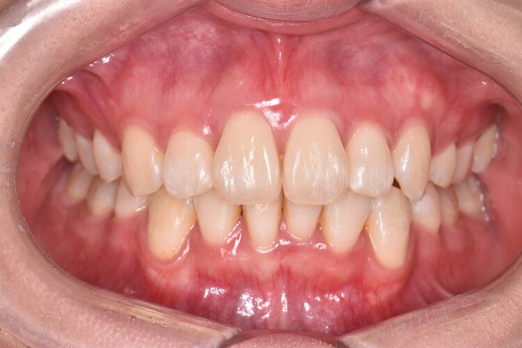 治療後（写真1）