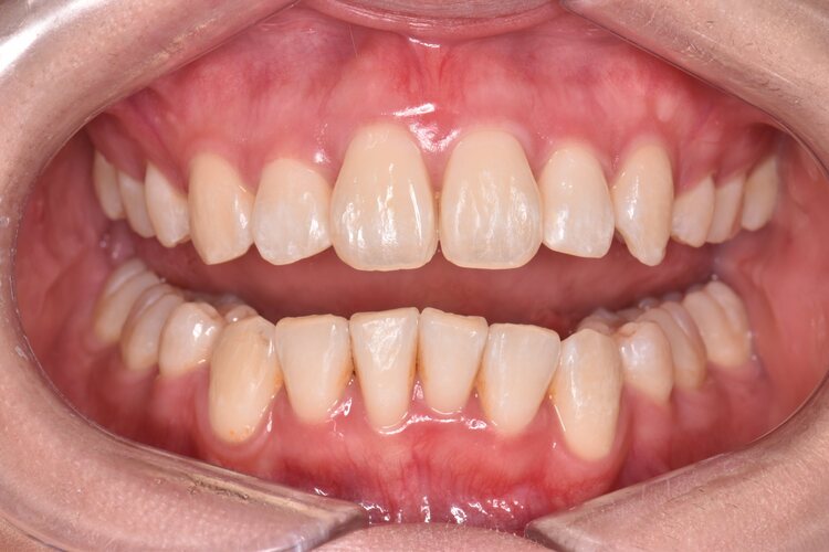 治療後（写真2）