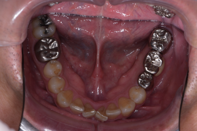 治療前（写真2）