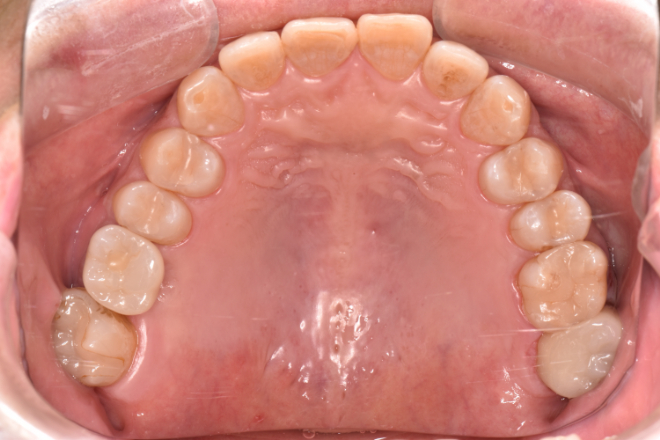 治療後（写真1）