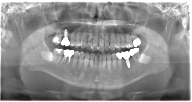 治療後（写真3）