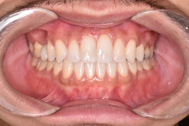 治療後（写真1）