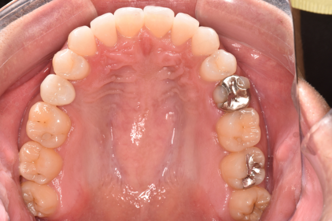 治療後（写真2）