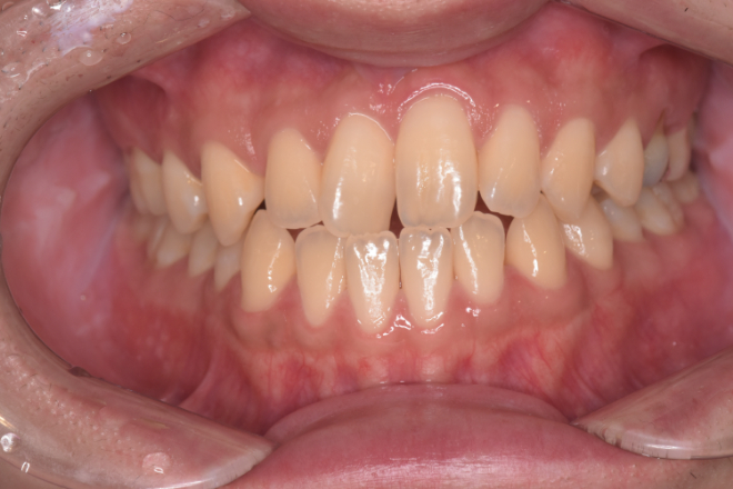 治療前（写真1）