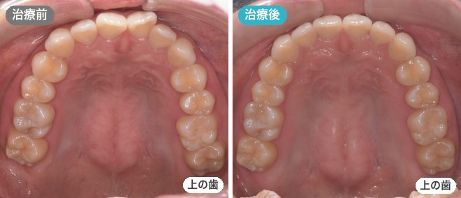 インビザライン・ライトの症例 治療前と治療後