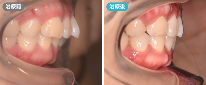 舌側ワイヤー矯正の症例 治療前と治療後