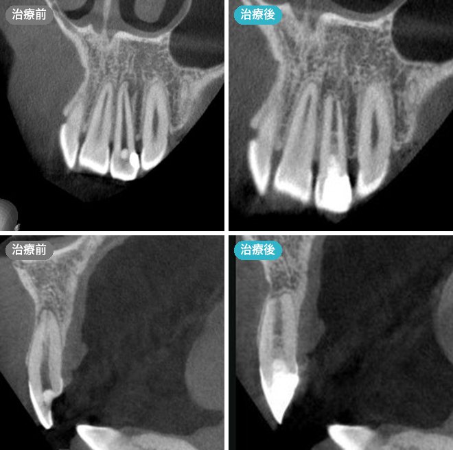 歯根端切除術を併用した歯髄再生治療の症例 治療前と治療後のCT画像