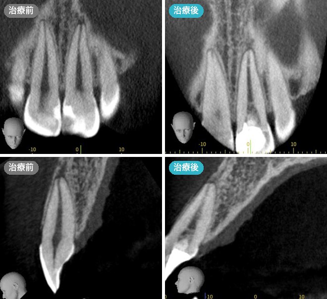 前歯の歯髄再生治療の症例 治療前と治療後のCT画像