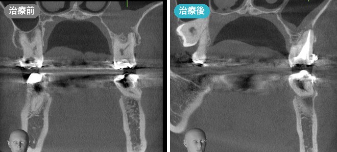 歯性上顎洞炎の精密根管治療の症例 治療前と治療後のCT画像
