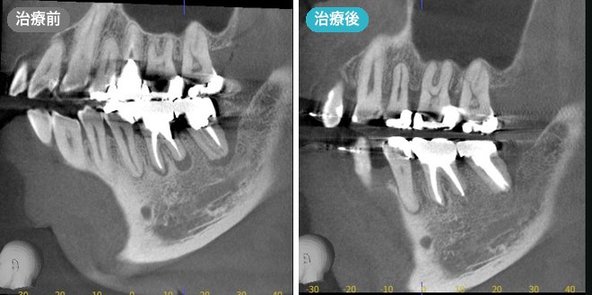 大臼歯の精密根管治療の症例 治療前と治療後のCT画像