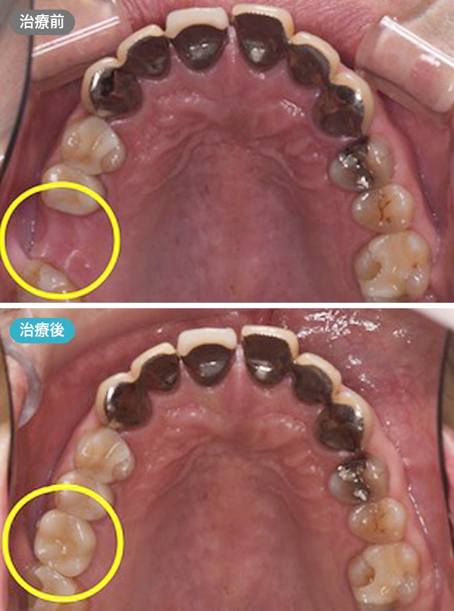 症例写真 治療前と治療後