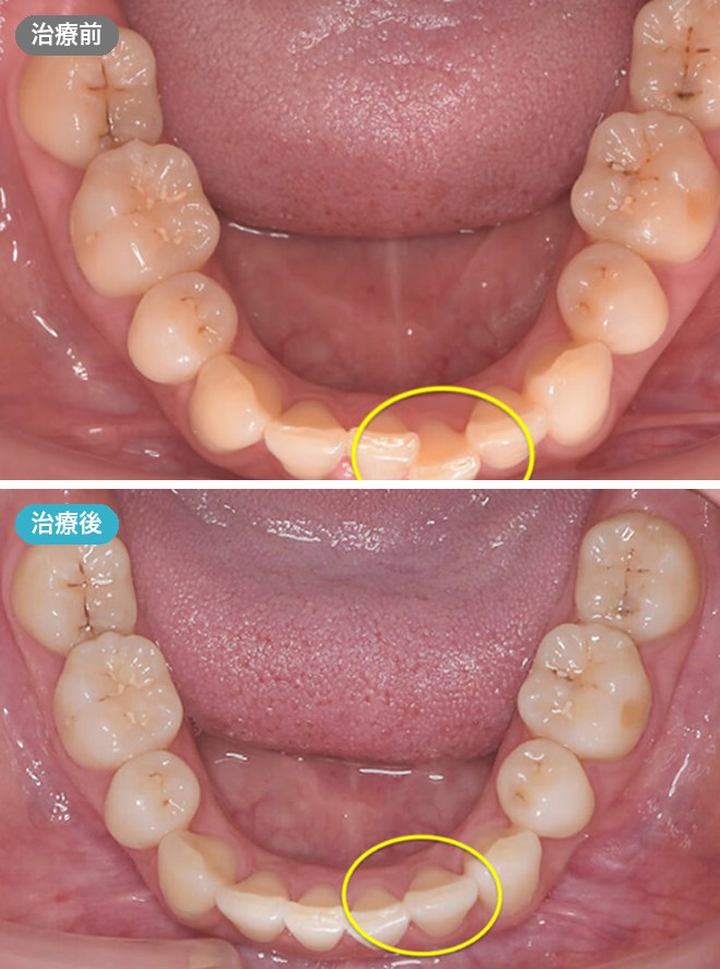 症例写真 治療前と治療後