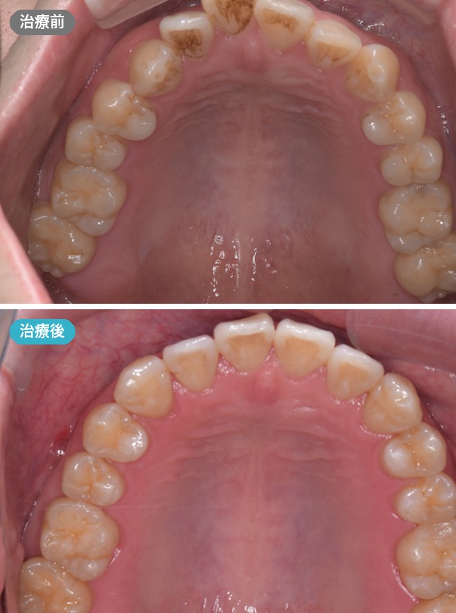 症例写真 治療前と治療後