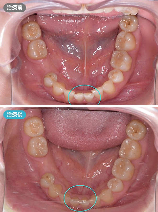 症例写真 治療前と治療後