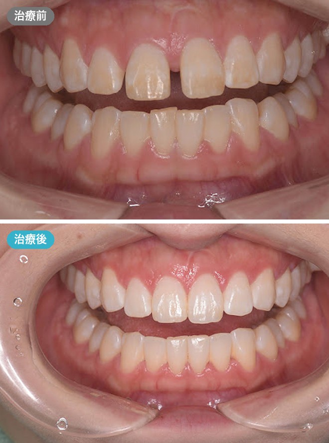 症例写真 治療前と治療後