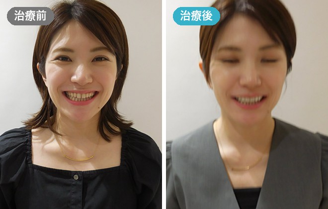 ラミネートベニア8本の症例 治療前と治療後(お顔全体)